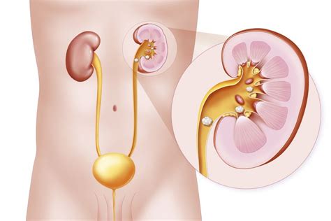 Nefrolitiaza Pietre La Rinichi Semnele I Simptomele Precoce Pe Care