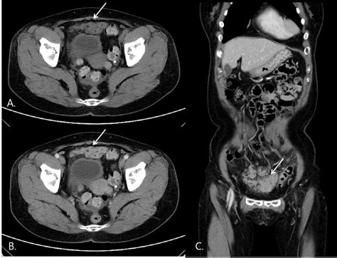 Figure 1 From Imaging Features Of Primary Peritoneal Serous Carcinoma