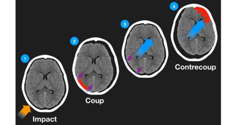 Tramatic Brain injury Flashcards | Quizlet