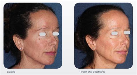 Stellar Lumenis M Resurfx Treatments Mediglow Cork