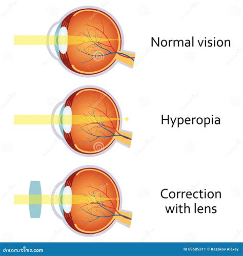 Hyperopia Corrected By A Plus Lens Stock Vector Image 69685311