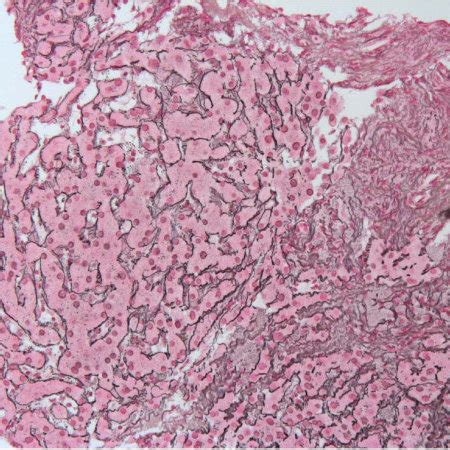 A Liver Biopsy Performed In September Shows In The Reticulin Stain