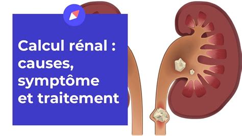 Comment Savoir Si Jai Des Calculs Rénaux Youtube