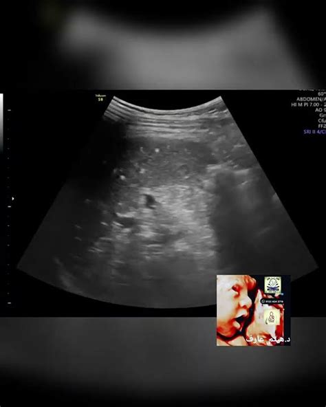 Splenic Siderosis With Gamna Gandy Bodies Ultrasound By Dr Haissam