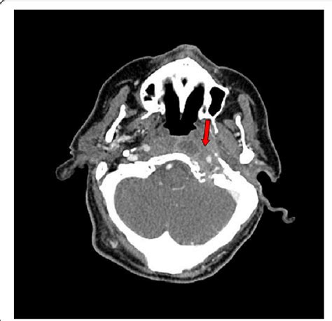 Cranial Computed Tomography Scan Shows A Mass Of Soft Tissue Arrow