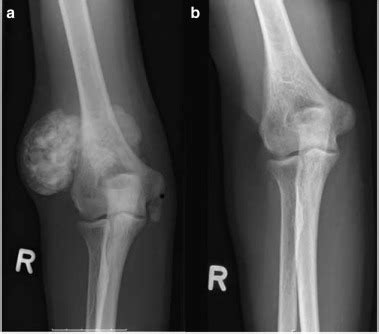 Uremic Tumoral Calcinosis Improved By Kidney Transplantation Kidney