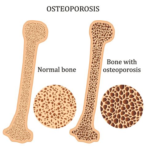 OSTEOPOROSIS AND PH CONNECTION PH FocusedpH Focused