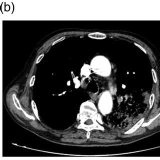 (a) Computed tomographic pulmonary angiography showing progress of left ...