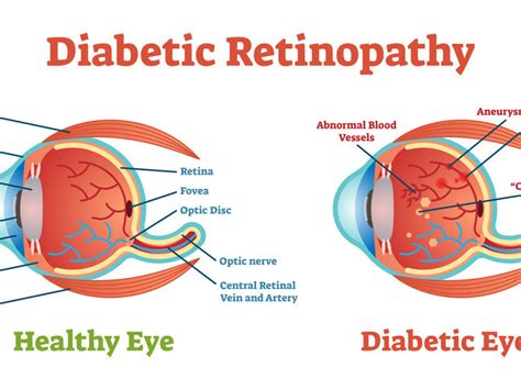 Retinopatia Diabetica Meteda Investe In Nuove Tecnologie Per La