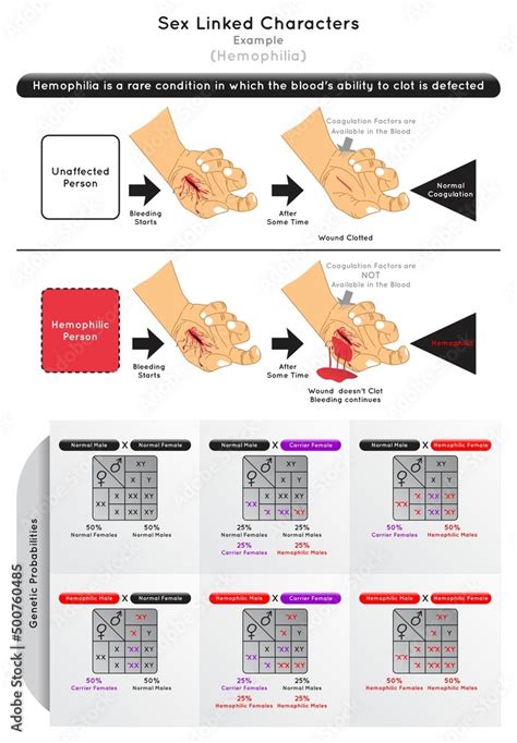 Sex Linked Characters Infographic Diagram Example Hemophilia Bleeding