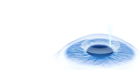 Corneal Refractive Workflow