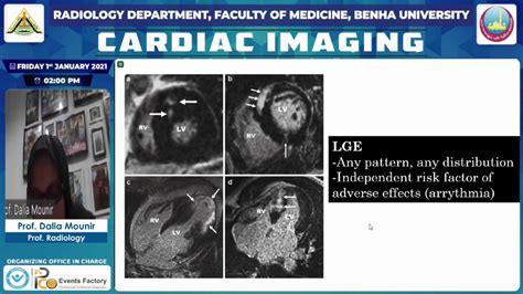 Non Ischemic Cardiomyopathy YouTube