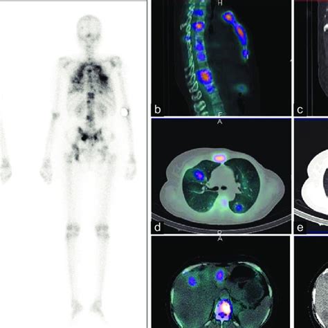 Typical examples of four types of bone metastasis. The arrow indicates ...