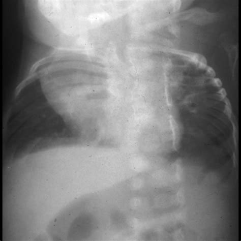 Pulmonary Hypoplasia | Pediatric Radiology Reference Article ...