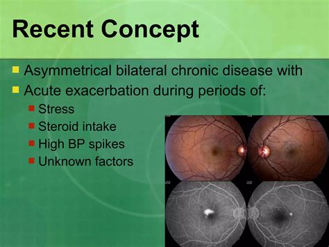 Central Serous Retinopathy | PPT