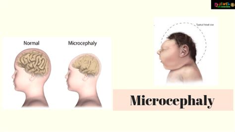 Microcephaly | Signs and Symptoms of Microcephaly