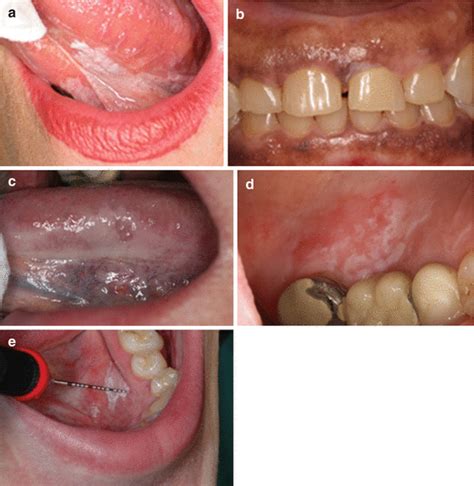 Oral Lesions Differential Diagnosis