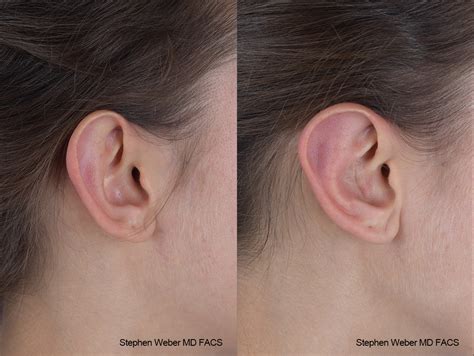 Otoplasty Before And After 45 Weber Facial Plastic Surgery