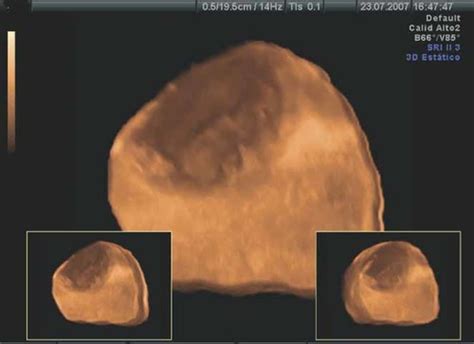 Three‐dimensional Ultrasound Diagnosis Of Ruptured Subcapsular Liver Hematoma Caused By Hellp