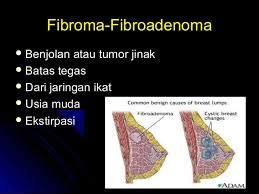 Cara Mengobati Fibroadenoma Mammae Pengobatan Kronis Terampuh