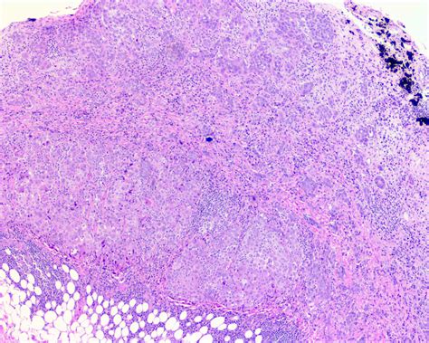 Epithelioid Mesothelioma Pathology Outlines - Goimages 411