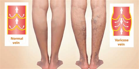 5 Stages Of Vein Disease That Need To Be Taken Seriously