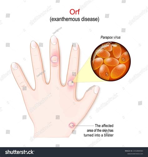 Orf Exanthemous Disease Humans Hand Affected Stock Vector (Royalty Free