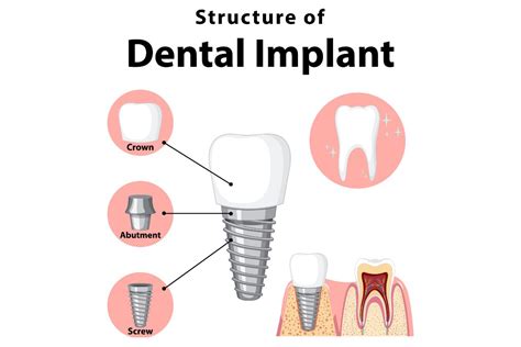 Understanding Dental Implants The 3 Essential Parts And How They Work