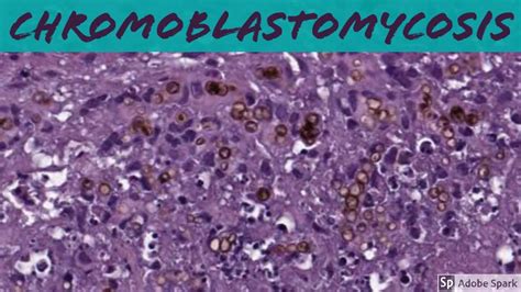 Chromoblastomycosis (Dematiaceous Black Mold Fungus Infection): 5 ...