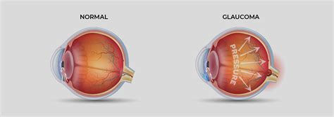 Glaucoma Dr Sergio Pimentel Oftalmologista