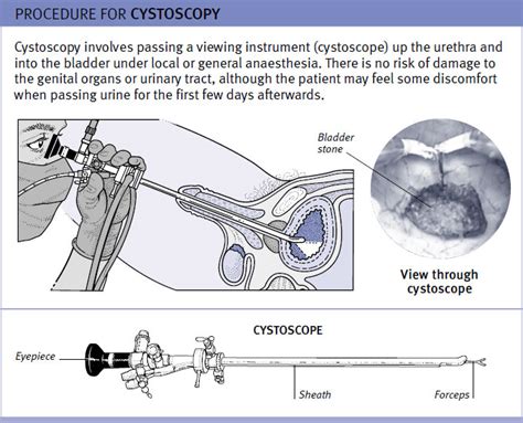 cystoscopy ~ Nursing