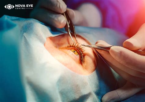 Types of Cataract Surgery | Nova Eye Centre