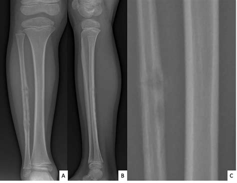 Anteroposterior A And Lateral B Radiographs Of Right Fibula Showing