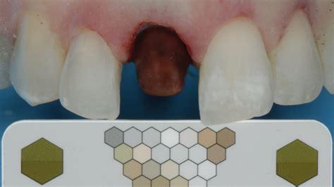 Solving the Single Tooth Dilemma - Oral Health Group