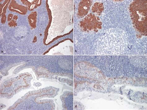 Warthin Tumor Ck7 Immunostain ×40 A ×100 B Ck56 Immunostain Download Scientific