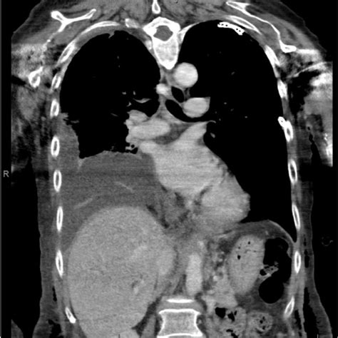 Day Ct Chest With Iv Contrast Impression Large Loculated Right