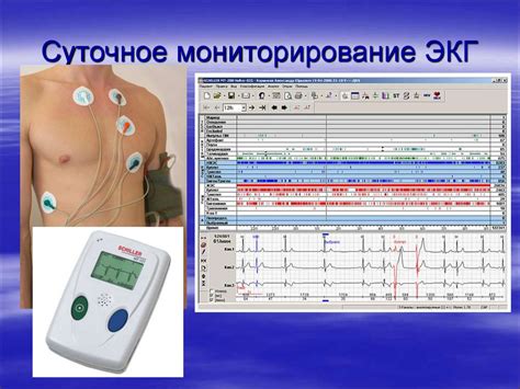 Как выглядит мониторинг сердца суточный фото
