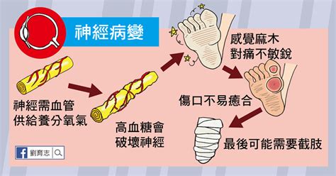 你有糖尿病嗎？（懶人包） 照護線上