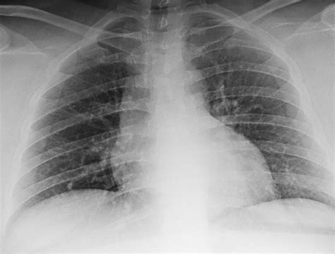 Social Distancing With Portable Chest Radiographs During The COVID 19