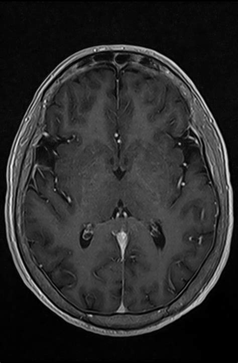 Planum Sphenoidale Meningioma Image Radiopaedia Org