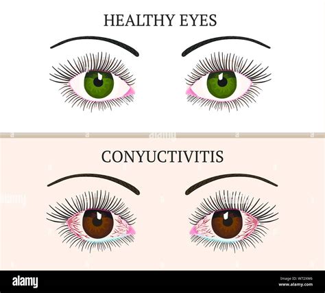 Los Síntomas De Conjuntivitis Ojos De Color Rosa Enfermedad De Los