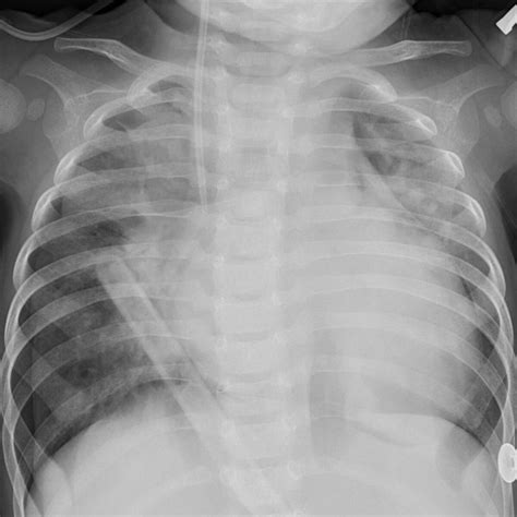 [beginner] Chest X Ray Image Classification Kaggle