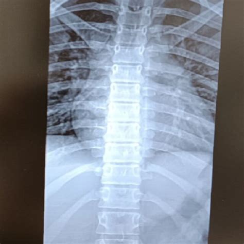 Dorsal Spine X Ray For Patient 1 Download Scientific Diagram