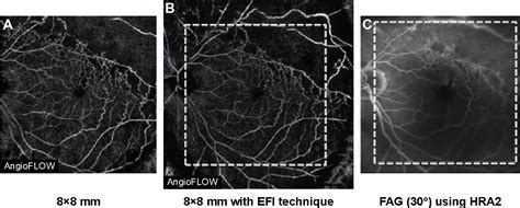 Figure 3 From Clinical Ophthalmology Dovepress Dovepress Wide Field