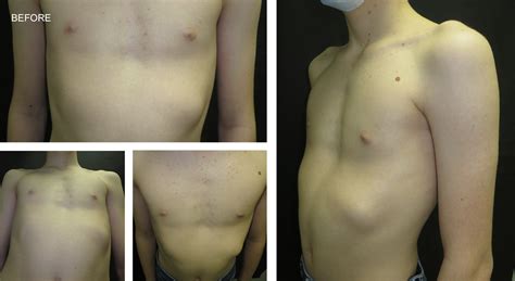 Vacuum Bell Therapy Vbt And Rib Flare Bracing For Pectus Excavatum