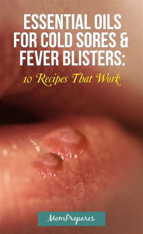 Essential Oils For Cold Sores And Fever Blisters 10 Recipes That Actually Work Mom Prepares