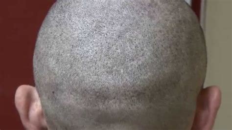 Fue Minimal Scar 1 Year After Follicular Unit Extraction Hair Transplant Dr Diep Mhtaclinic