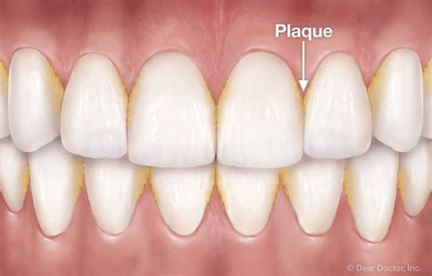 How to Floss Your Teeth | Dr. George P. Cerniglia | Metairie Louisiana