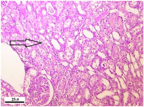 Necrotic And Detached Tubular Epithelial Cells In The Tubular Lumen