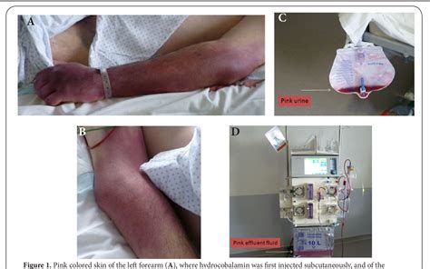 Figure 1 From Pink Skin Urine And Effluent Fluid After Cyanide